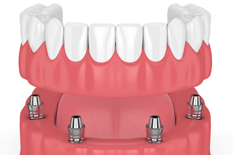 All-on-4 | Dental Implants | Fort Worth Dentist | Thomas L. Phillips Jr., DDS