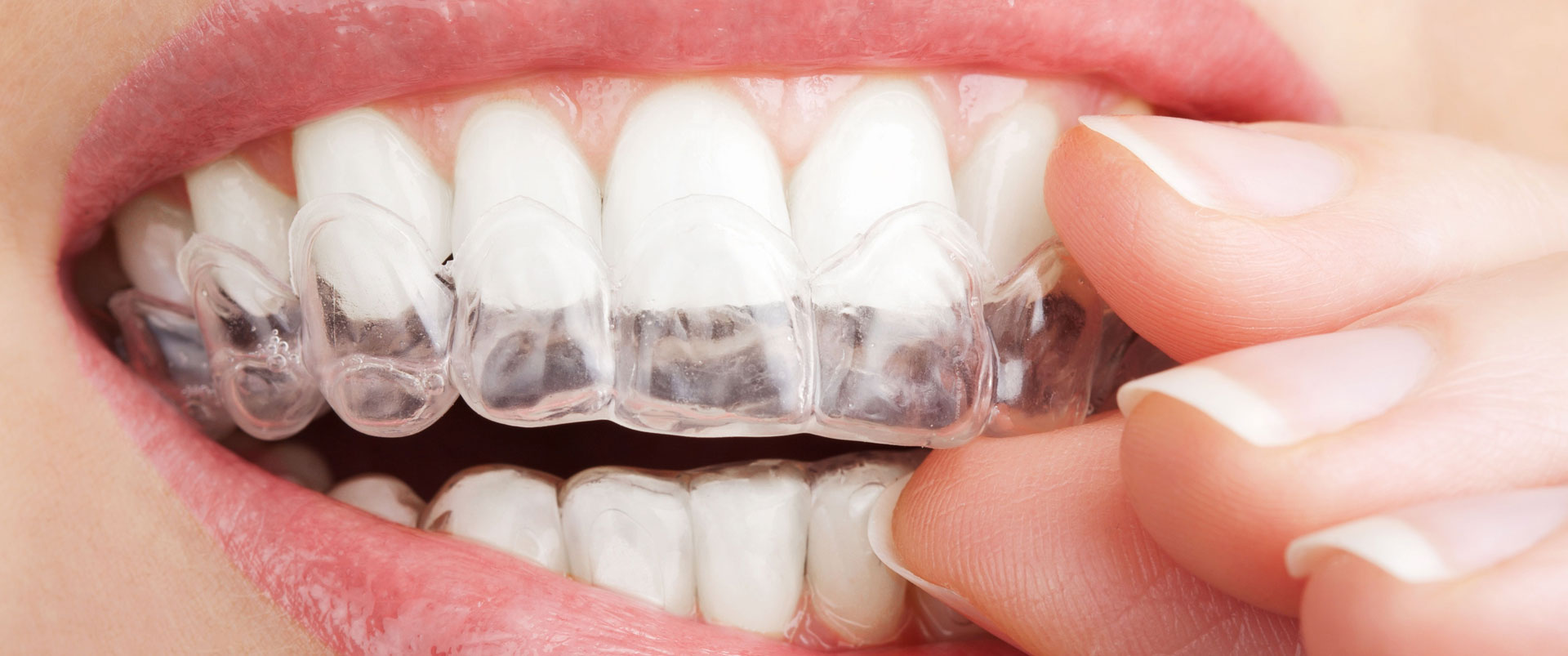 Clear Aligners | Fort Worth Dentist | Thomas L. Phillips Jr., DDS