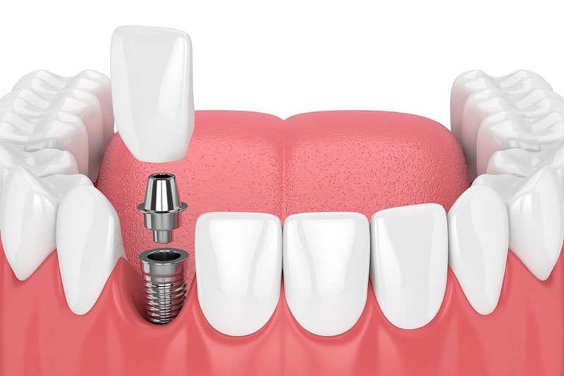 Dental Implants | Fort Worth Dentist | Thomas L. Phillips Jr., DDS