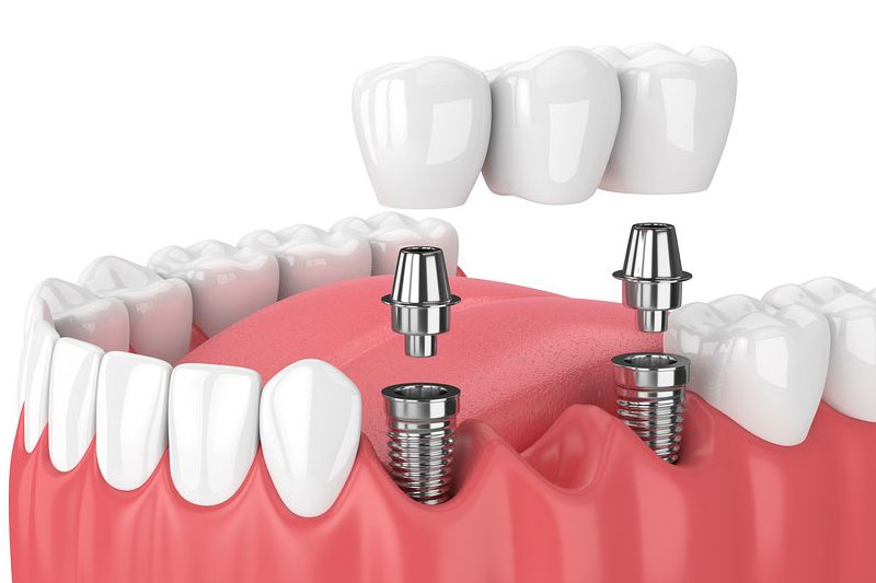 Hybrid Dentures | Fort Worth Dentist | Thomas L. Phillips Jr., DDS